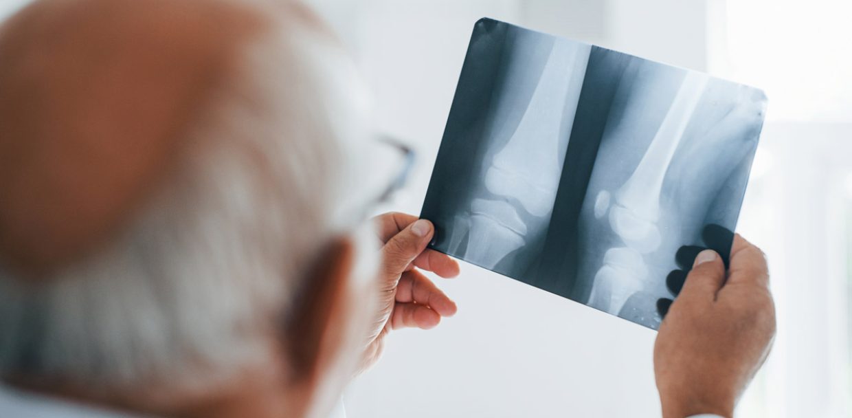 Senior man doctor in white uniform examines x-ray of human legs.